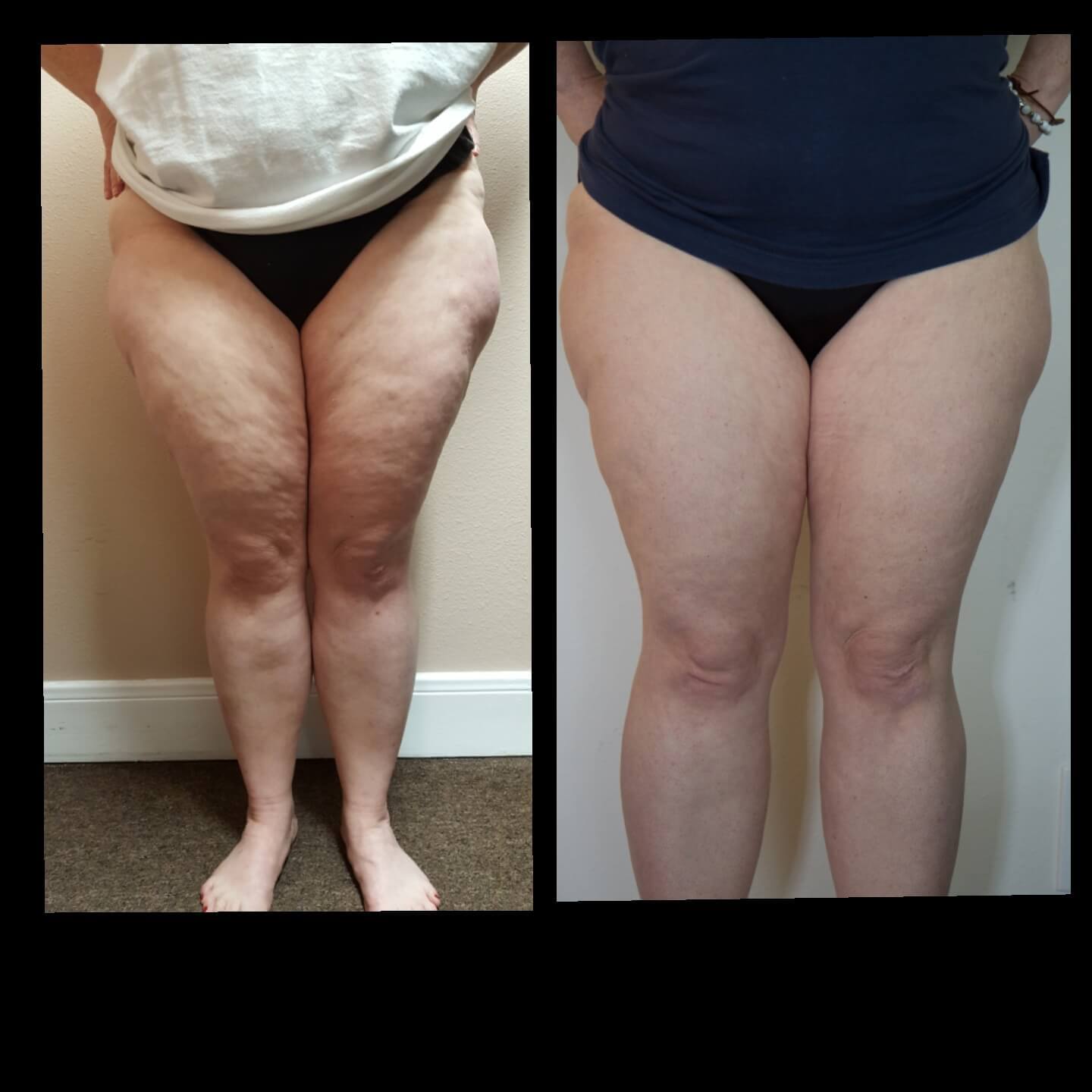 Before and after cellulite