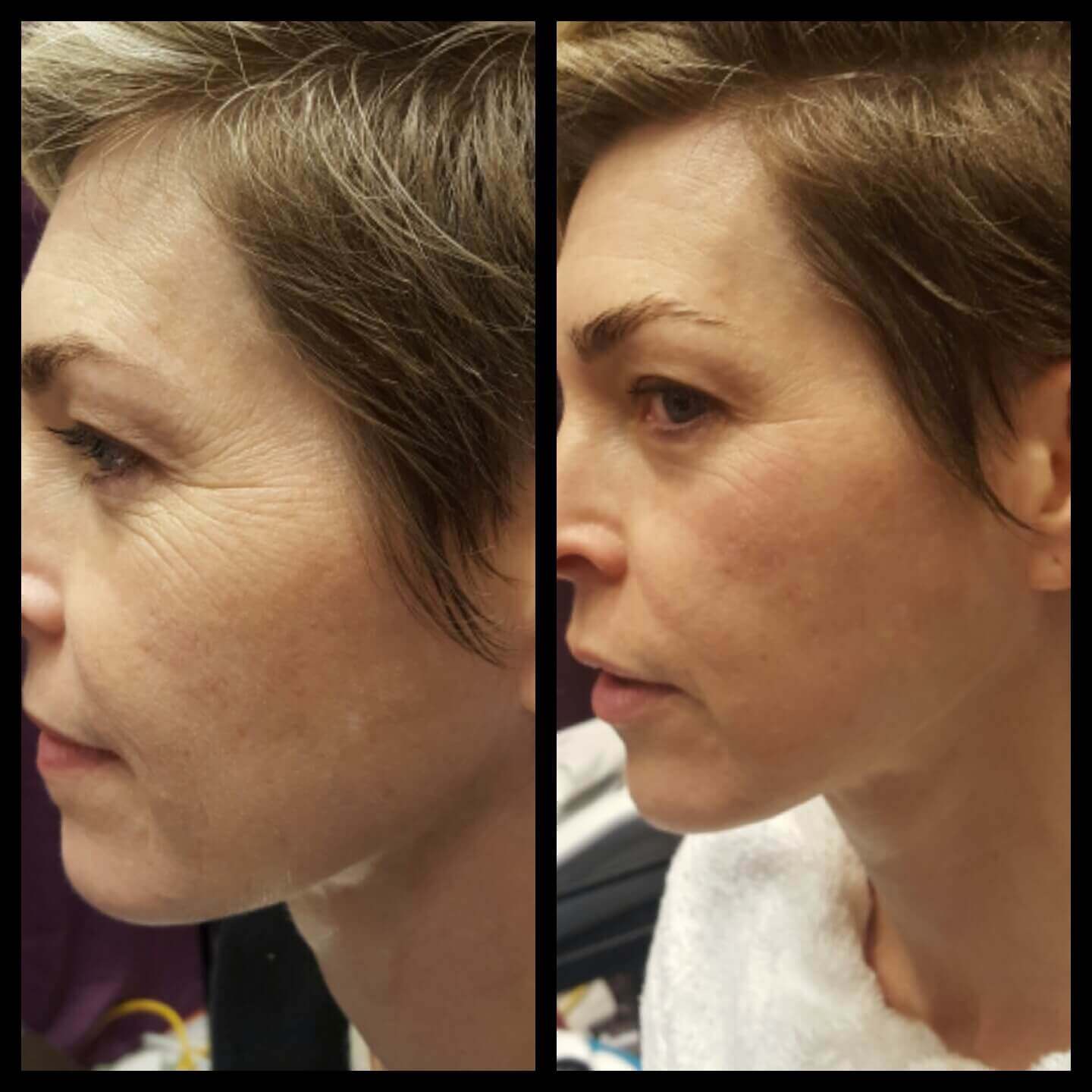 Side-by-side before and after photos of aesthetic procedure to reduce crows feet