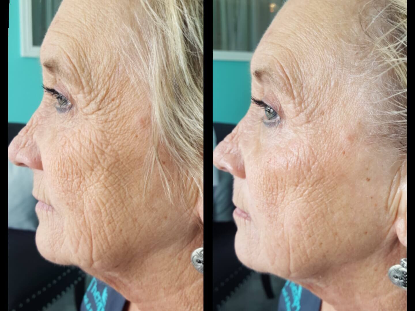 Before and after wrinkles