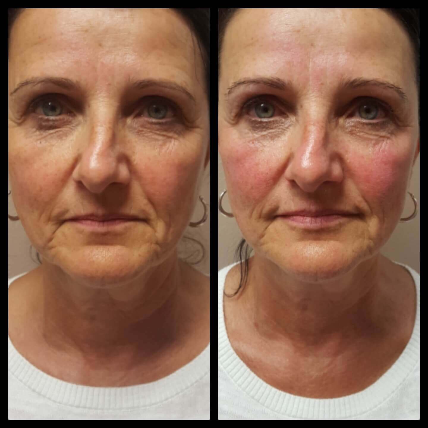 Facial results one session