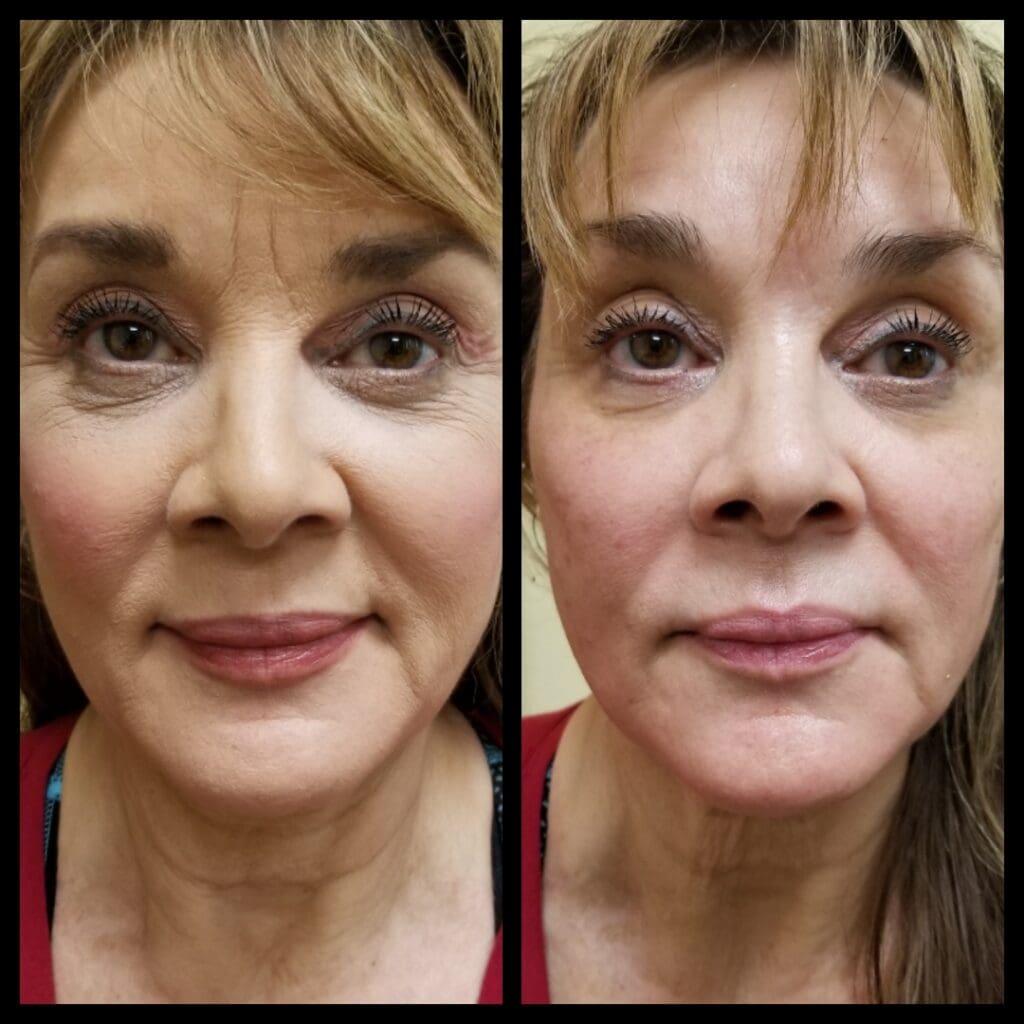 Side-by-side before and after comparison of facial wrinkles treated with peptide therapies near me