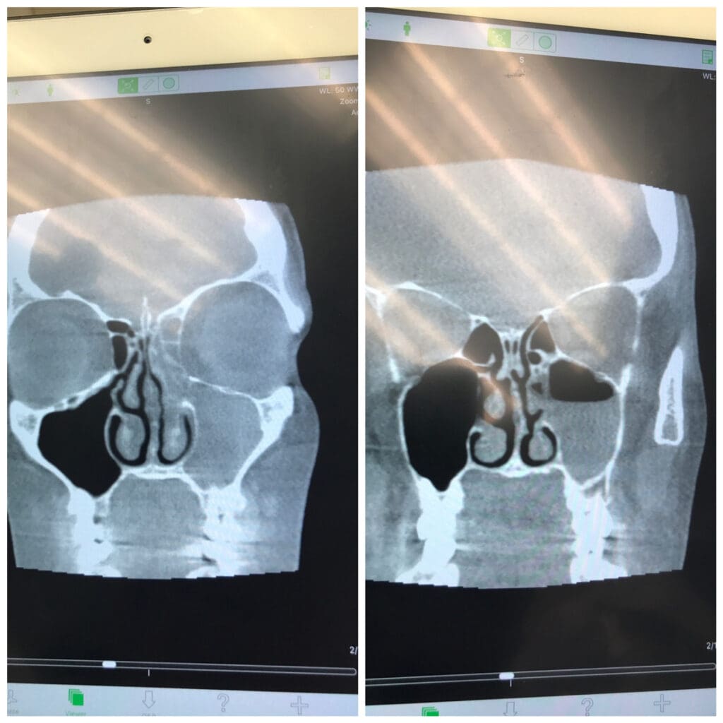 Here is a patients before and after sinusitis after the tecar therapy