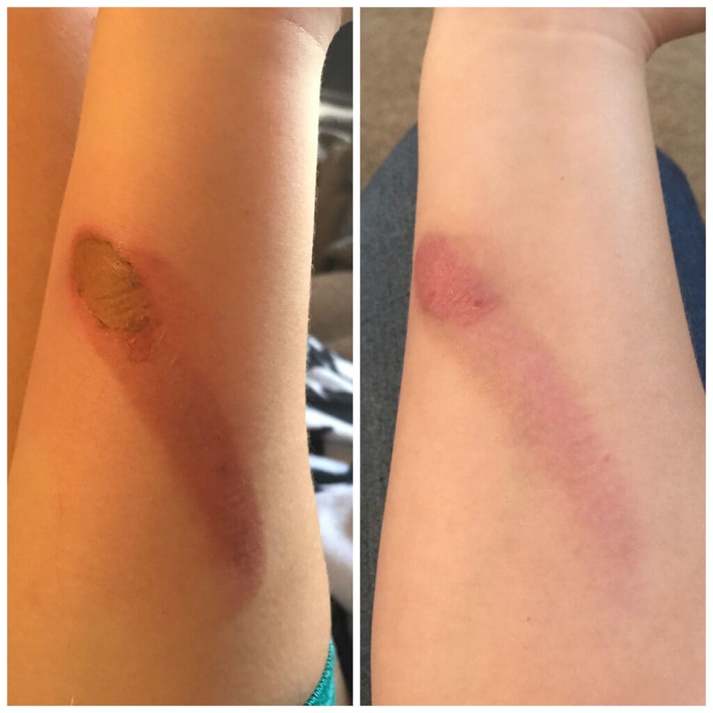 Before and after comparison of facial scar improved with peptide therapies near me