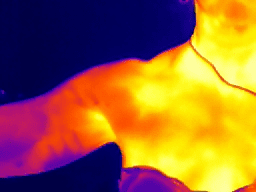 Heat map of the frontside of the shoulder after enacting shoulder impingement treatment 