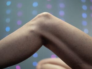 Treating Cyclist's Knee with TECAR Therapy